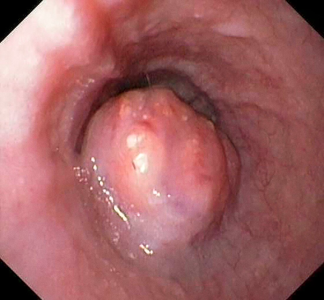 Oesophageal cancer,endoscopy image