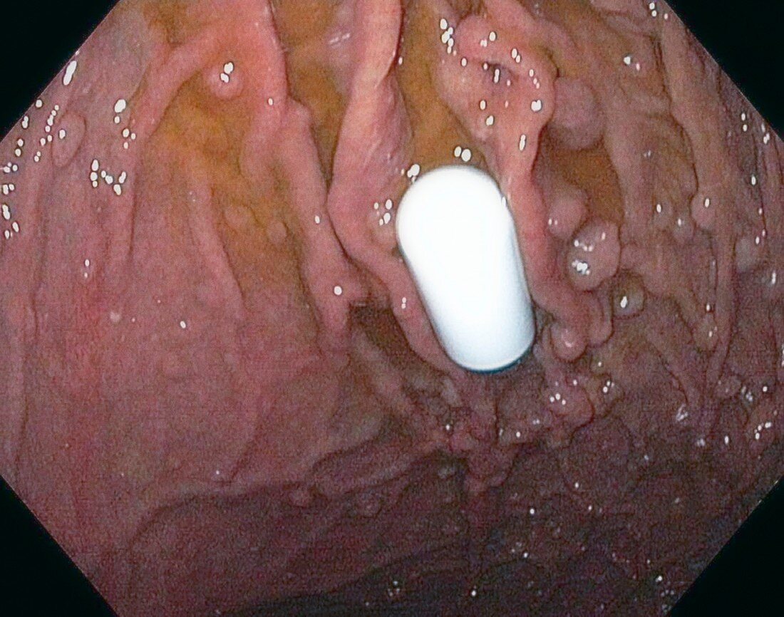 Gastric polyps and endoscopy camera capsule,endoscopy image