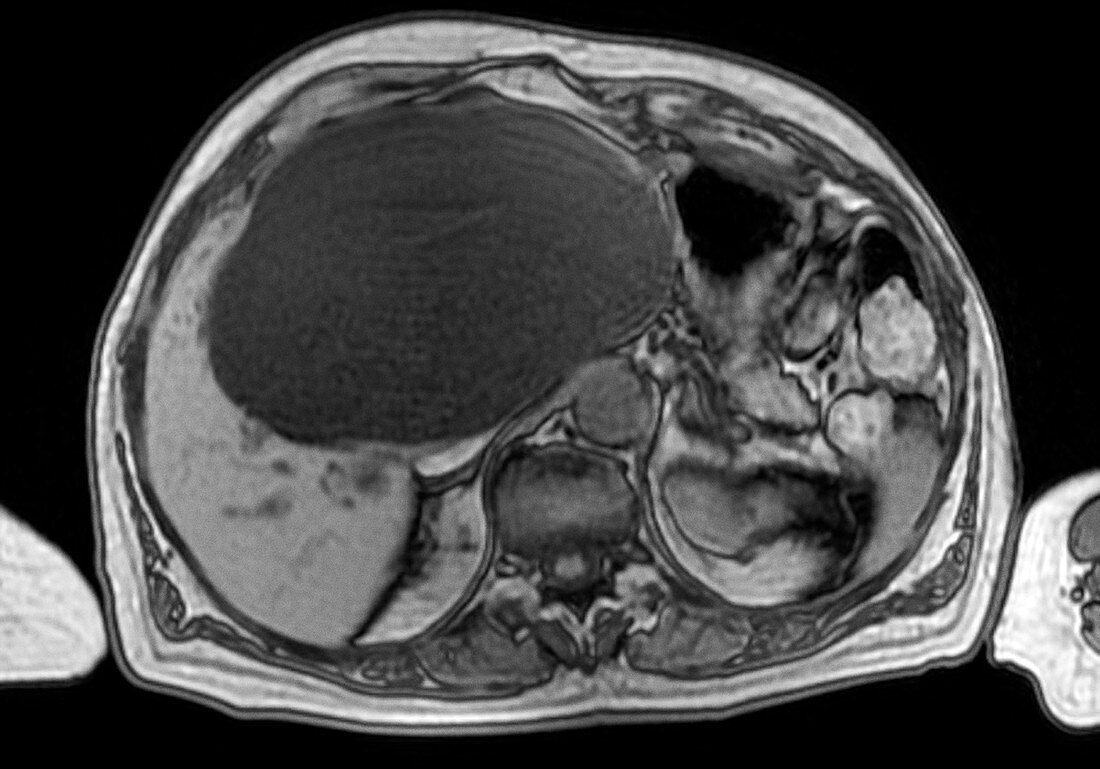 Liver cyst,MRI
