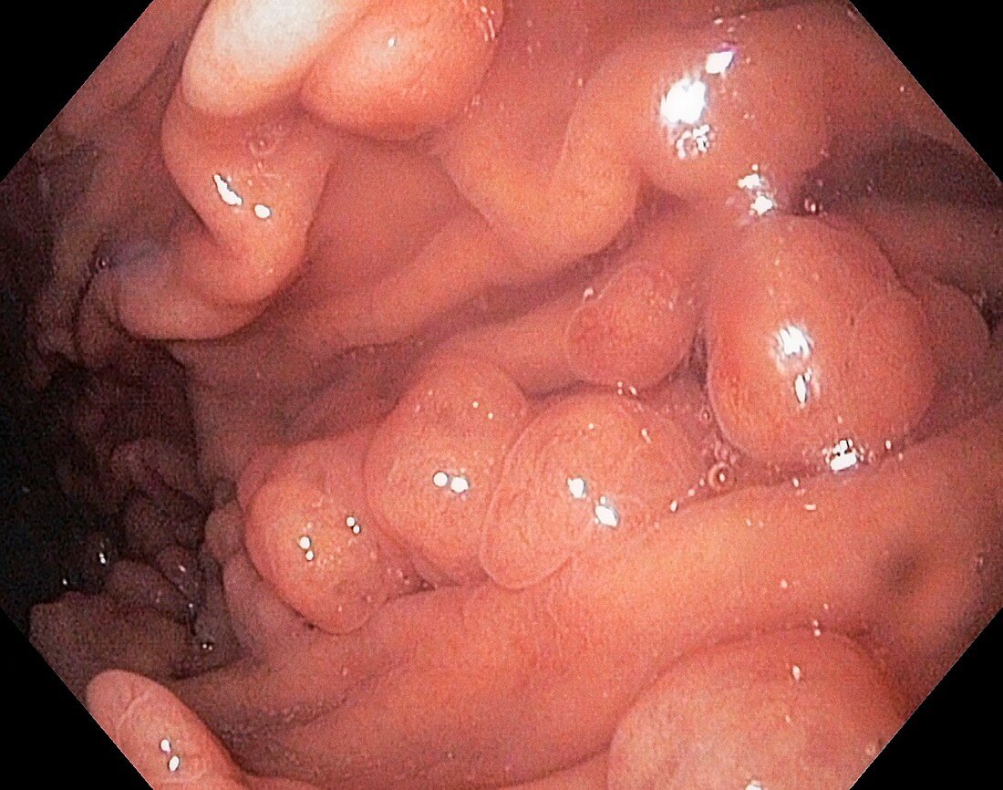 Intestinal polyps,endoscopy image