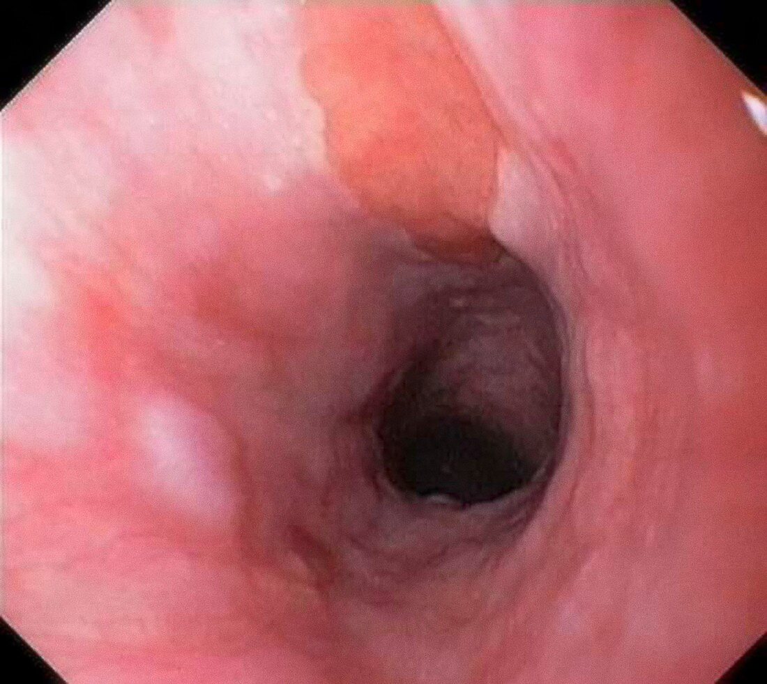 Oesophageal inlet patch,endoscopy image