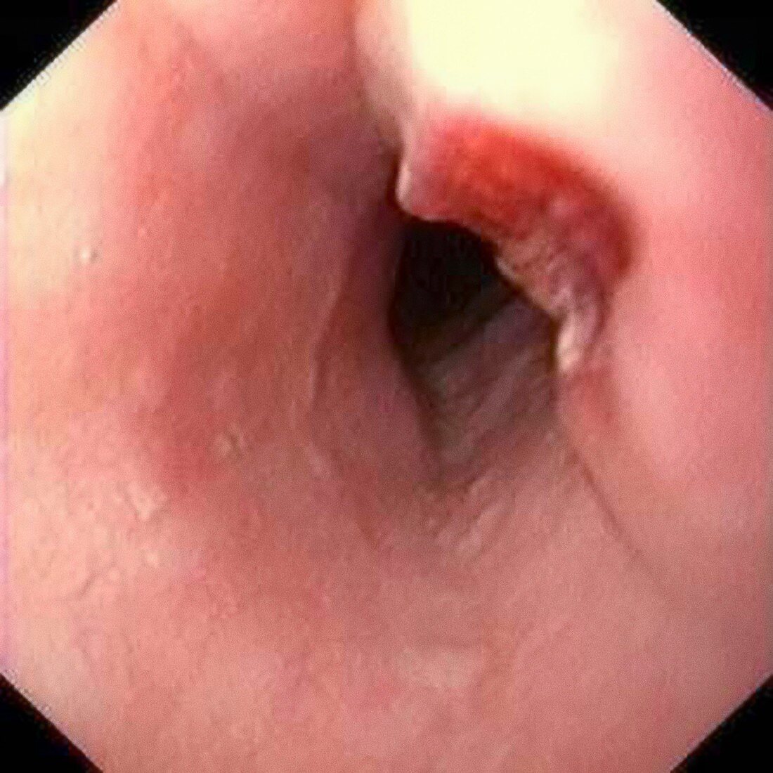 Oesophageal tuberculosis infection,endoscopy image