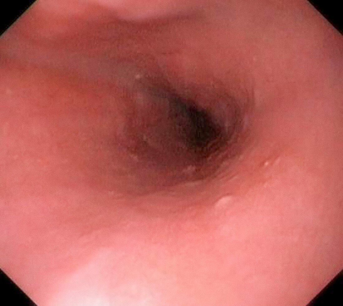 Normal oesophagus,endoscopy image