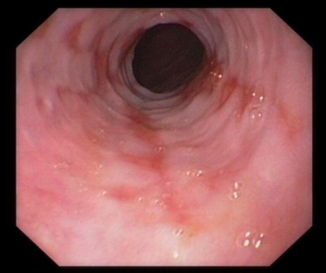 Gastroesophageal reflux disease,endoscopy image