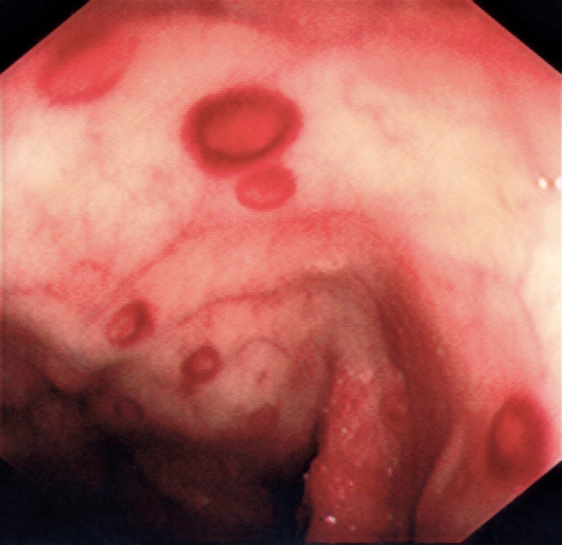Colitis in yersinia infection,endoscopy image