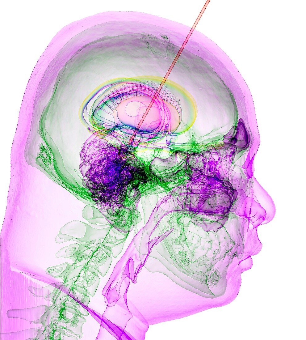 Deep brain stimulation,3D CT-based image