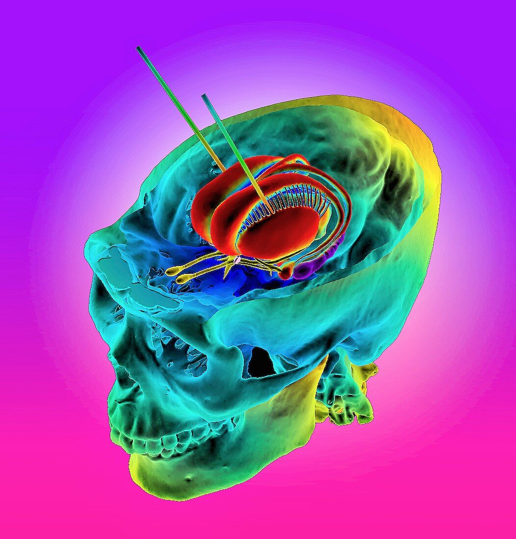Deep brain stimulation,3D CT-based image