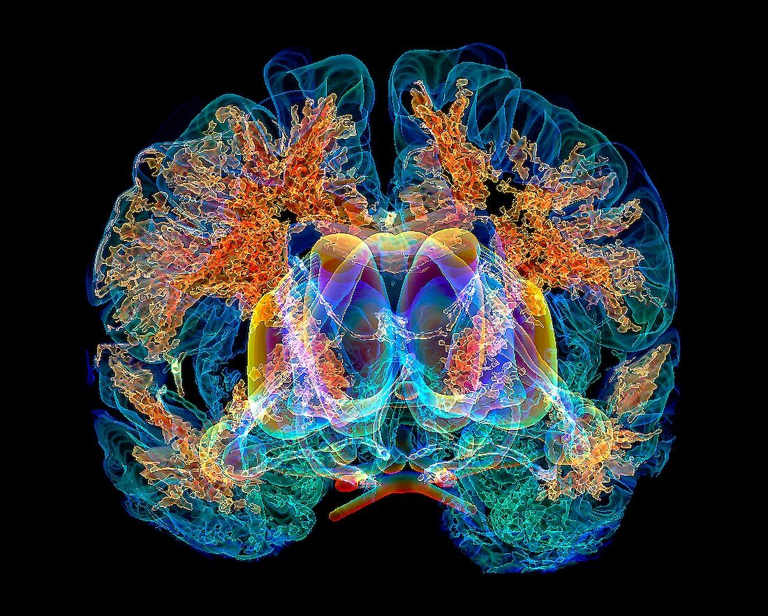 Stroke due to cerebral infarction,3D MRI scan