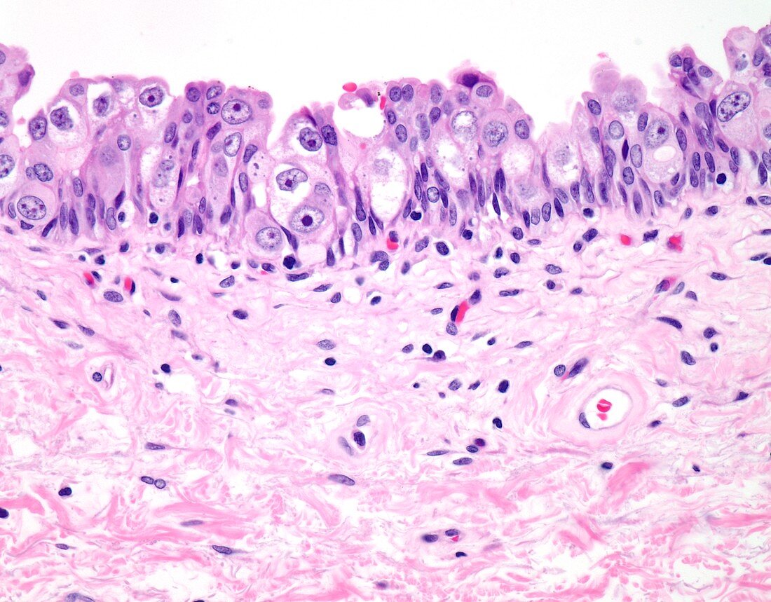 Urothelial carcinoma-in-situ,light micrograph