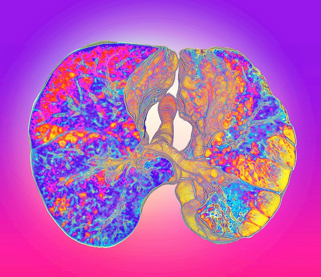 Emphysema lung disease,3D CT scan