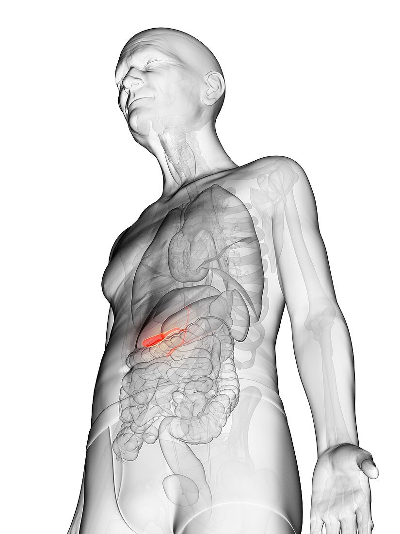 Illustration of an elderly man's gallbladder