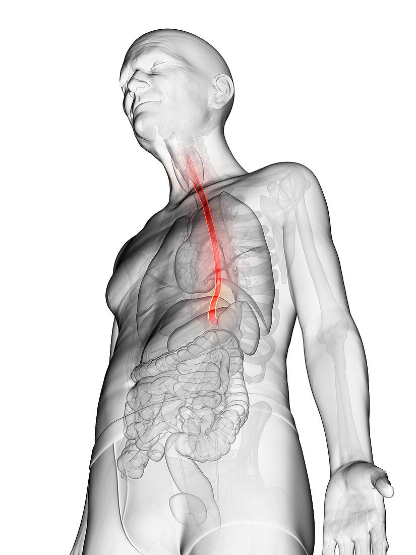 Illustration of an elderly man's esophagus