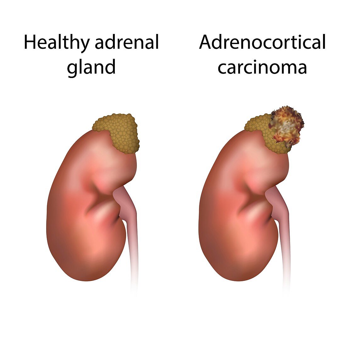 Adrenocortical carcinoma and healthy organ,illustration
