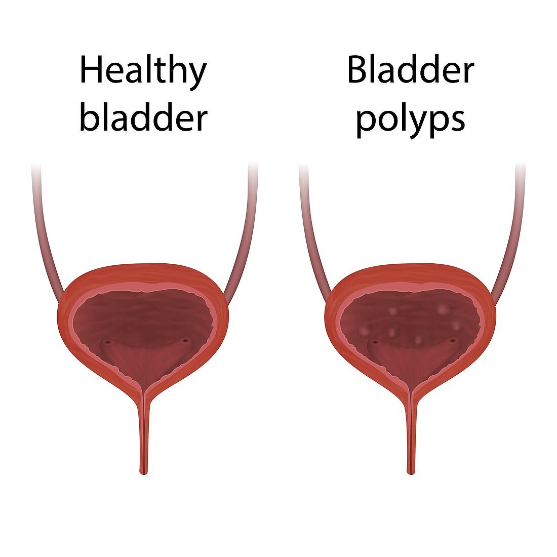 Bladder polyps and healthy bladder,illustration
