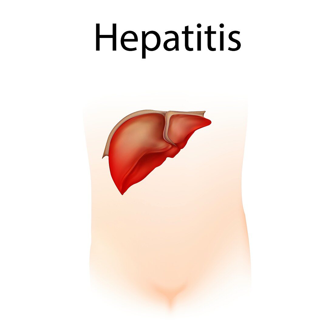 Hepatitis,illustration