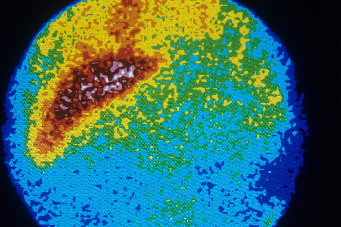 Liver cancer,scintigram