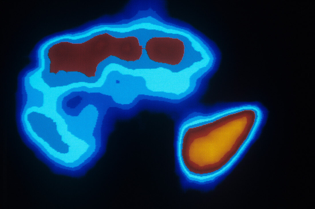 Liver cancer,scintigram