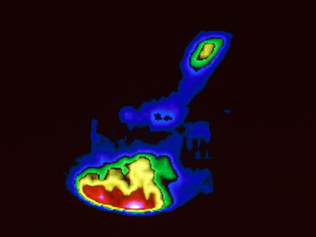 Stomach emptied in dyspepsia,gamma scan