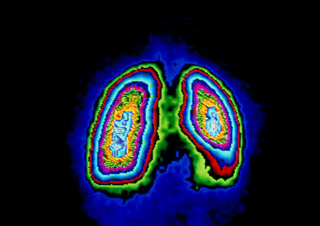 F/colour gamma scan of healthy human lungs