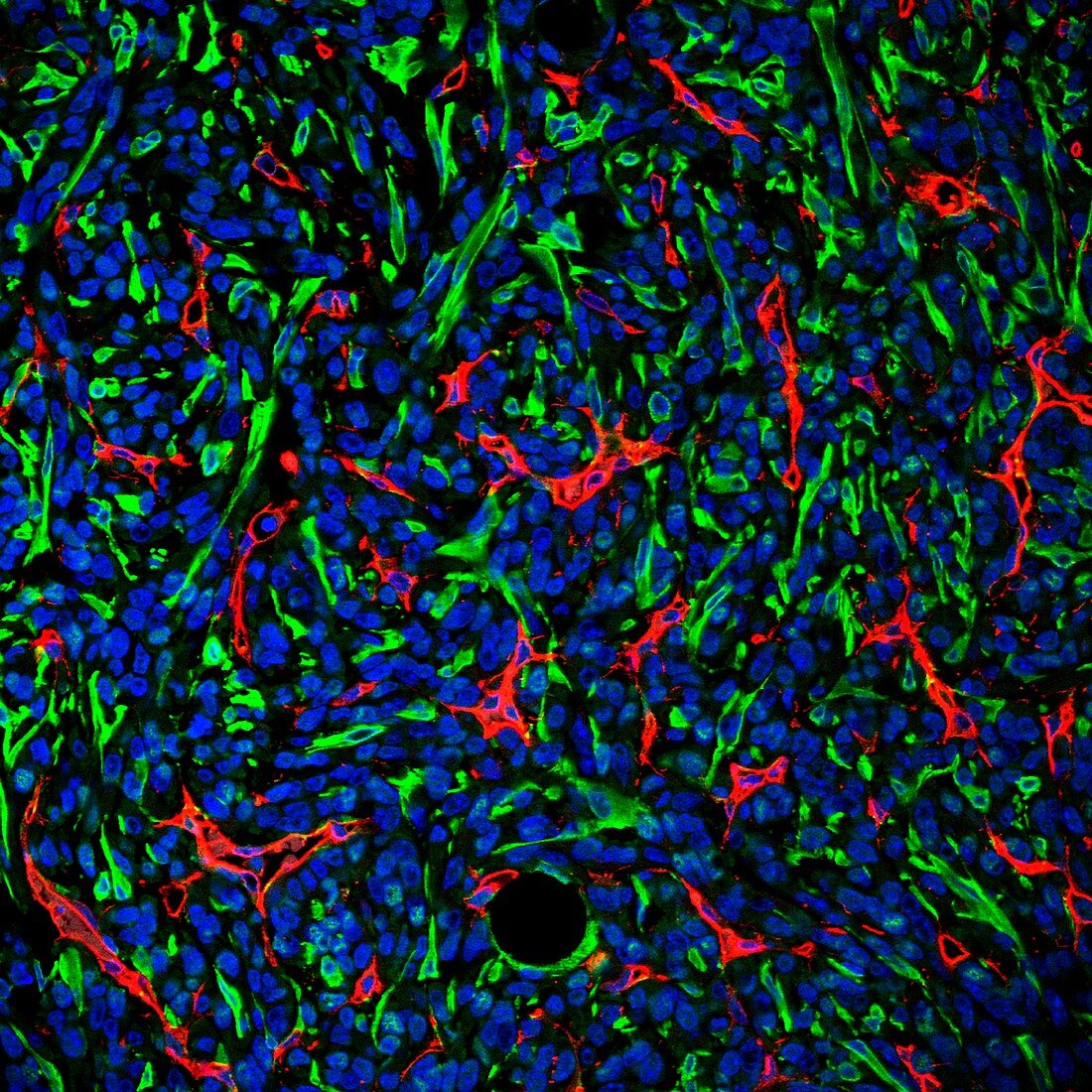 Breast cancer tumour tissue, confocal light micrograph