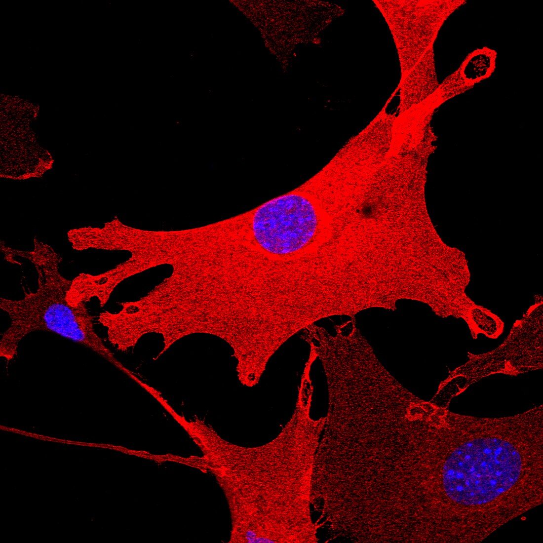 Cancer-associated fibroblasts, confocal light micrograph