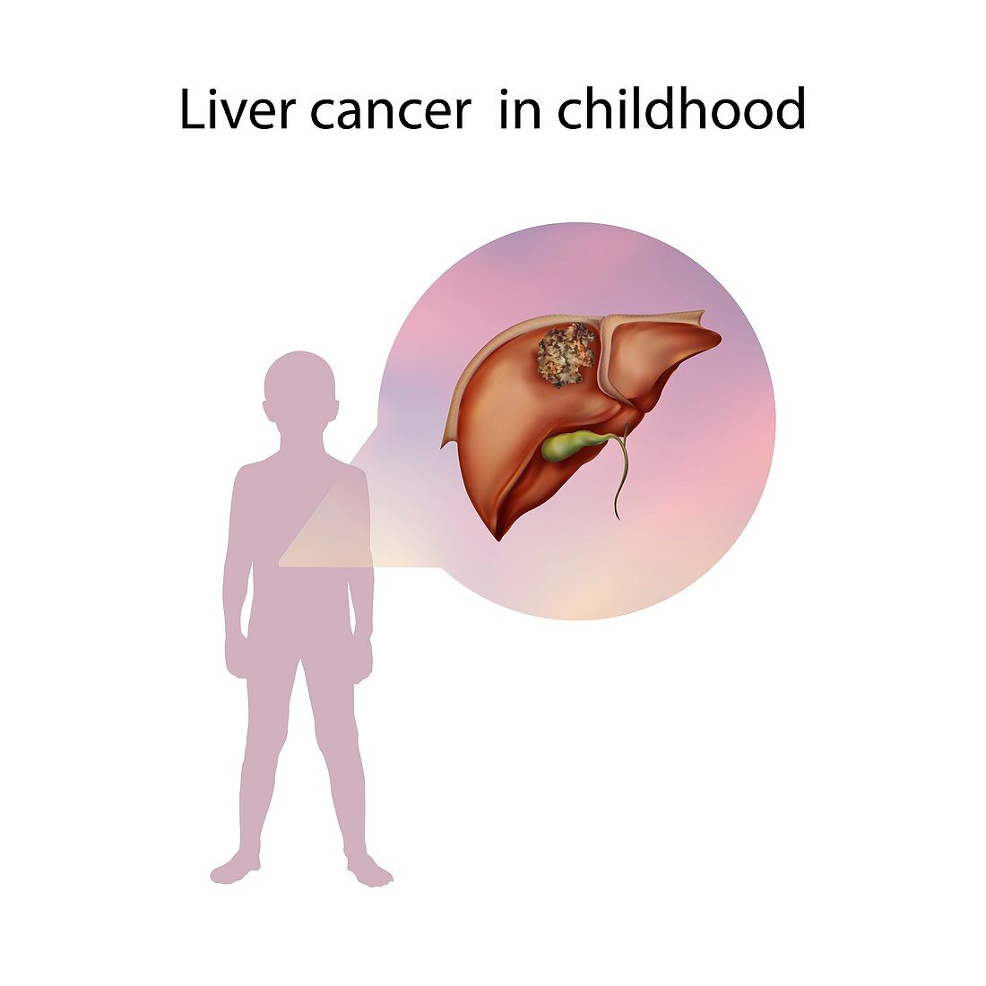 Liver cancer in childhood,illustration