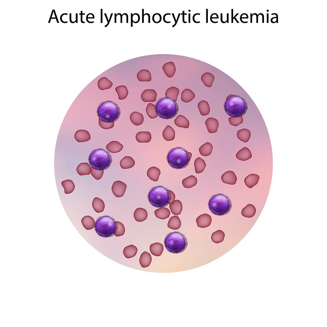 Acute lymphocytic leukaemia,illustration