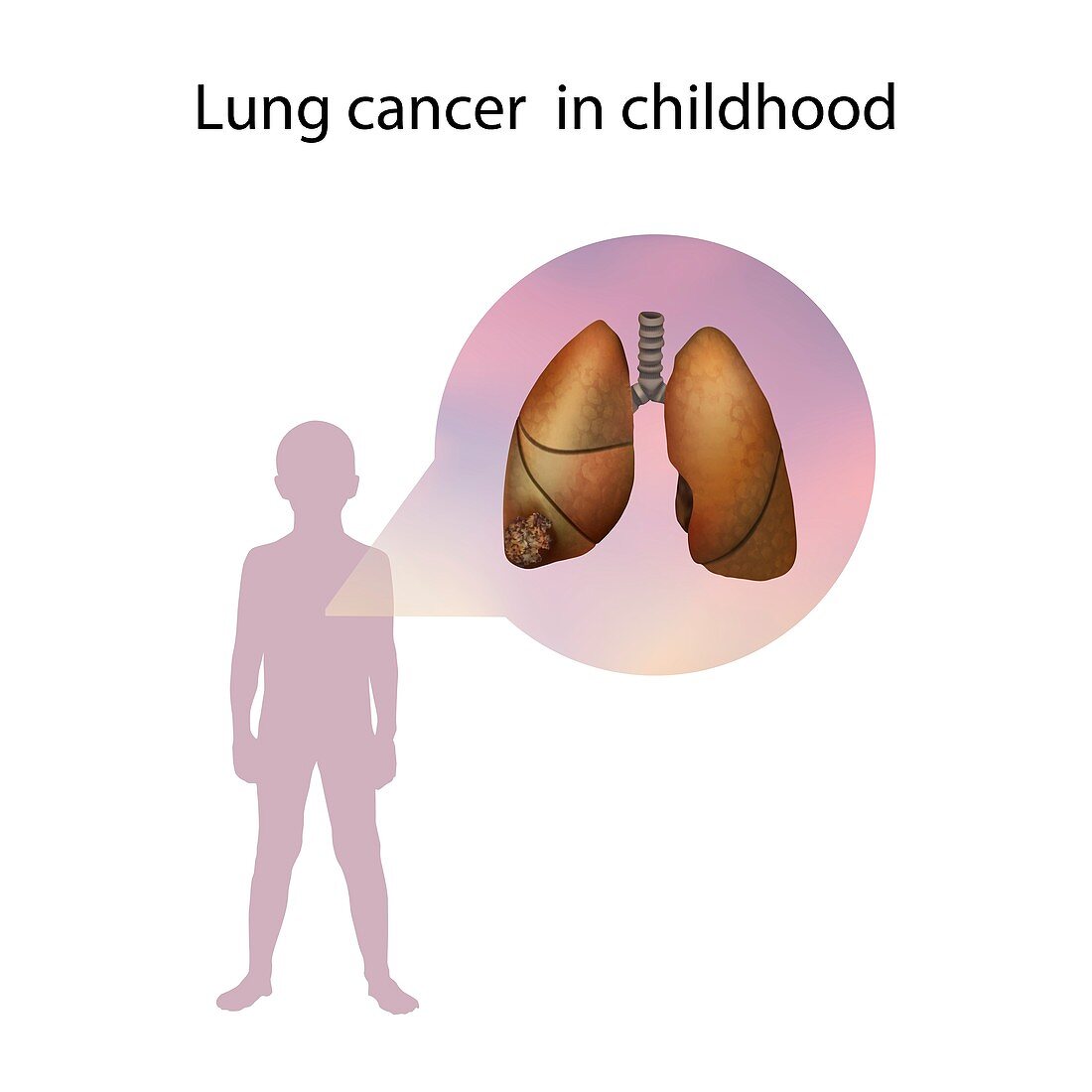 Lung cancer in childhood,illustration