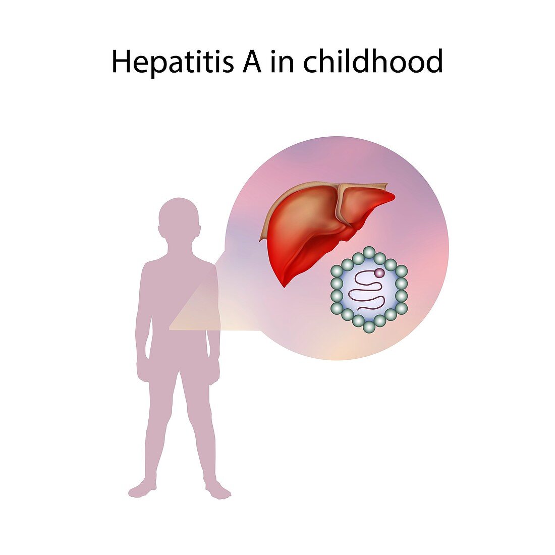 Hepatitis A in childhood,illustration