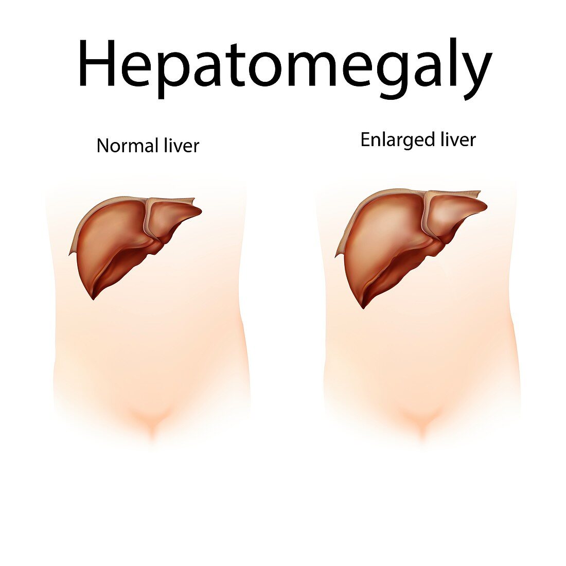 Hepatomegaly,illustration