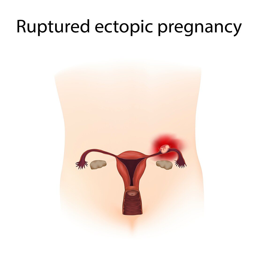 Ruptured ectopic pregnancy,illustration