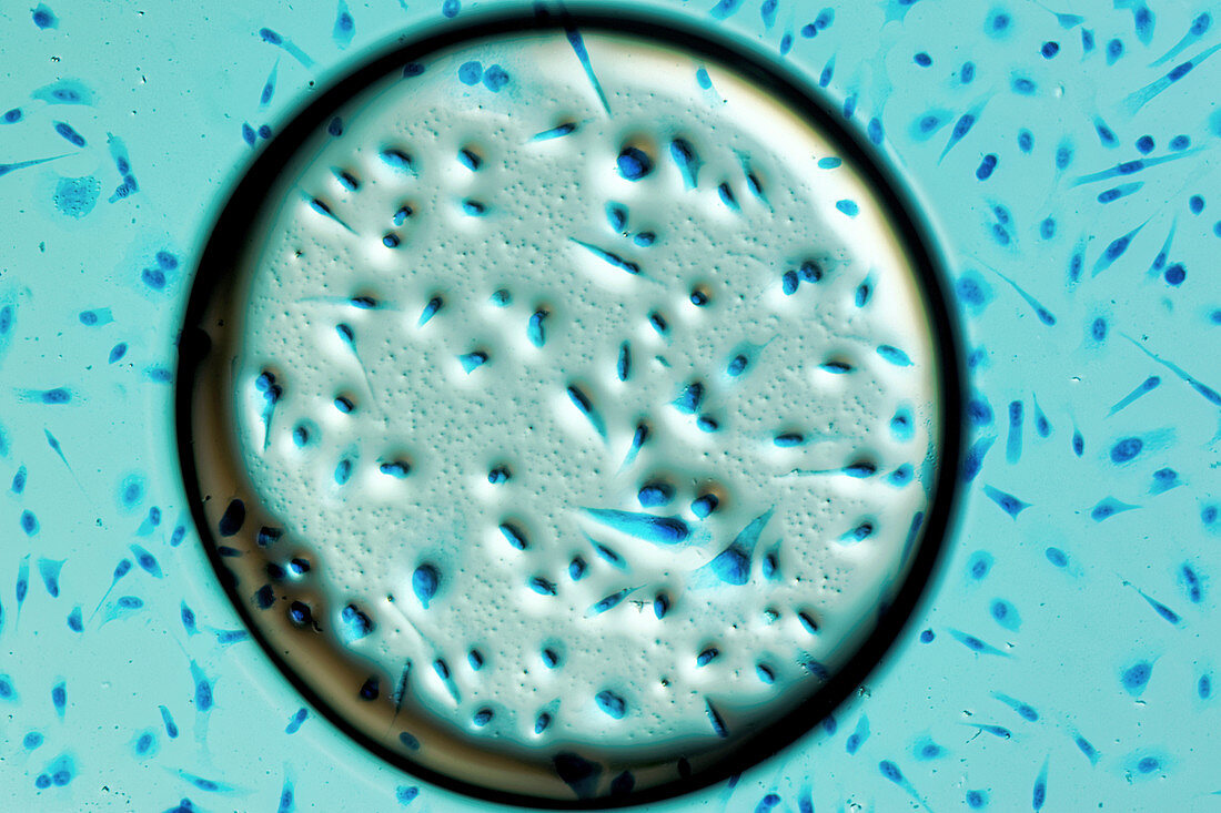 Human prostate cancer cells, light micrograph