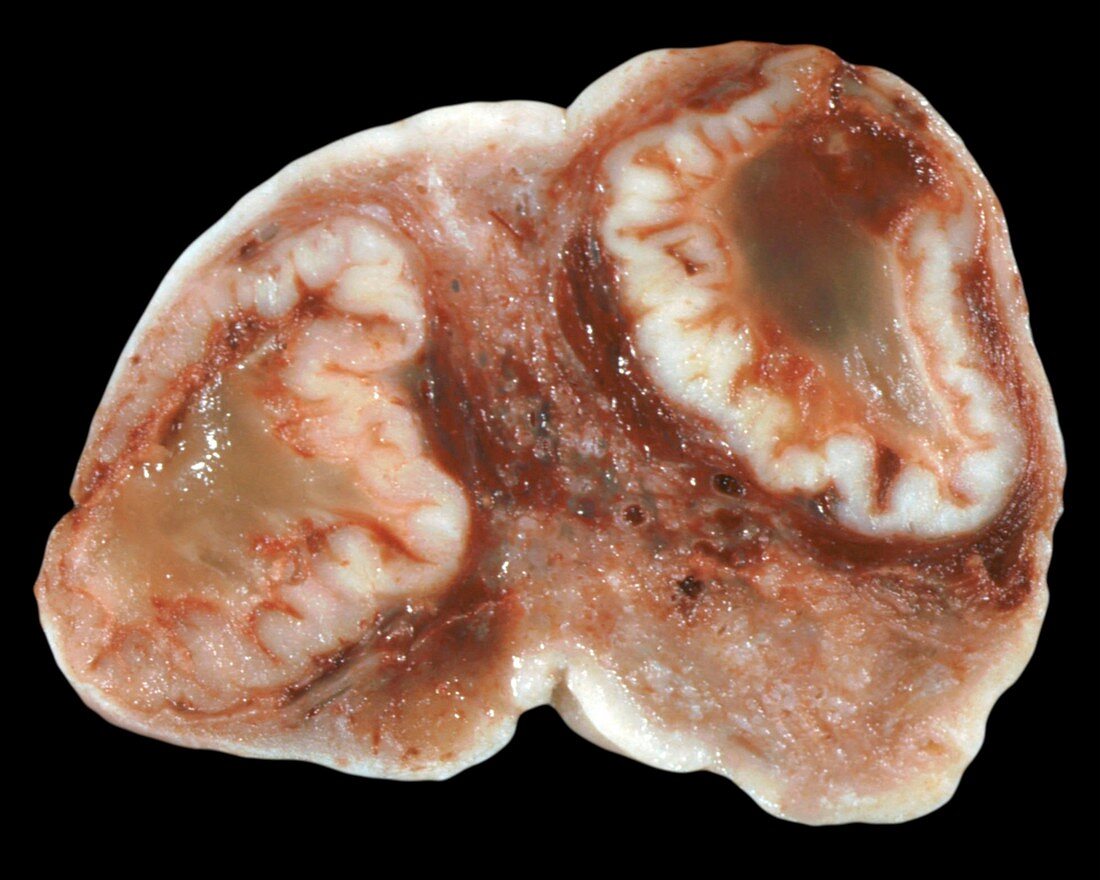 Human ovary with corpus luteum