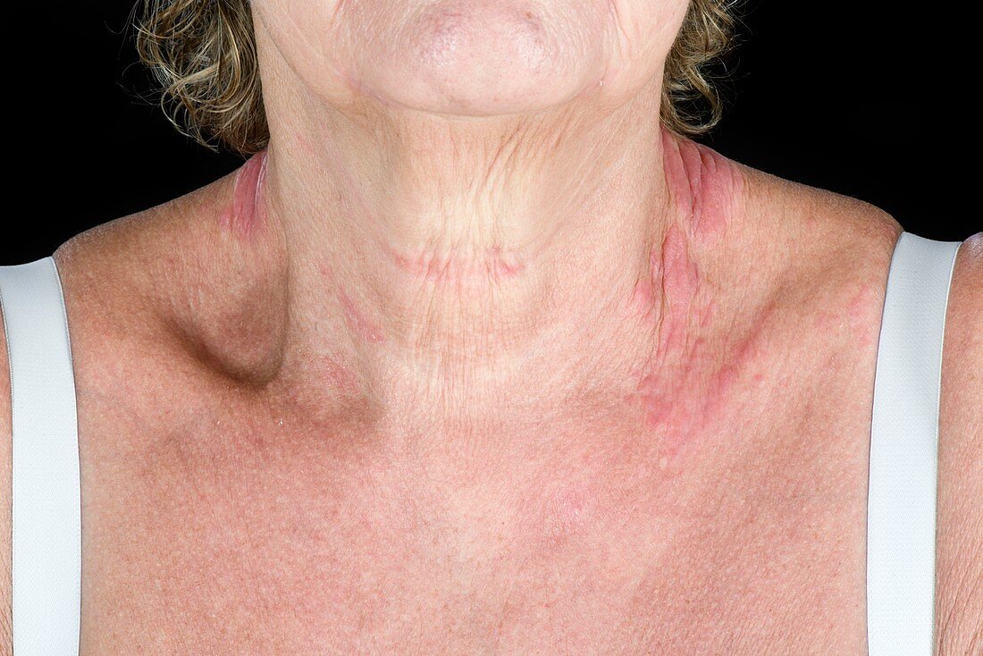 Eczema on the neck