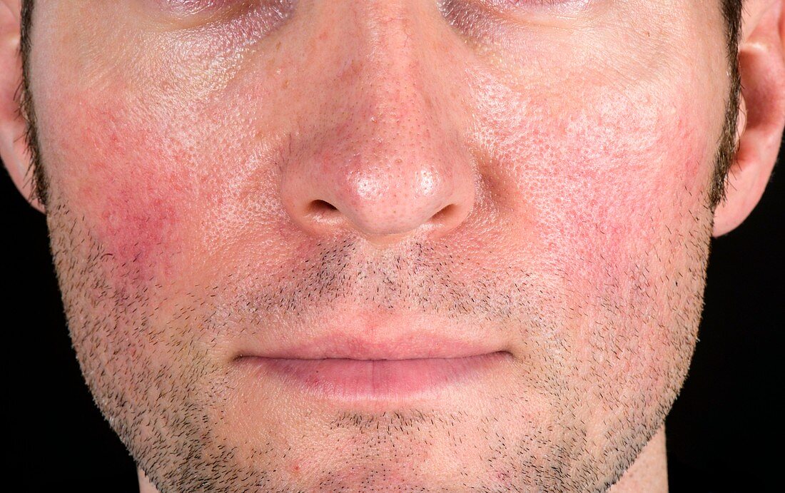 Acne rosacea