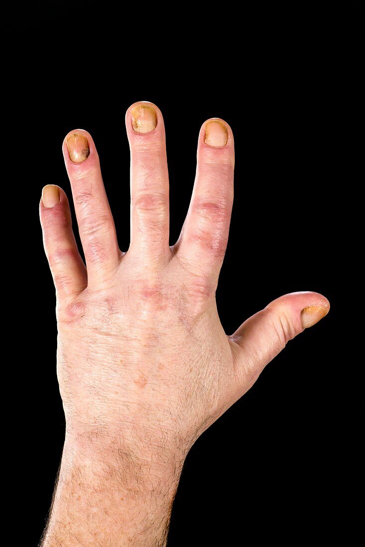 Dystrophic finger nails