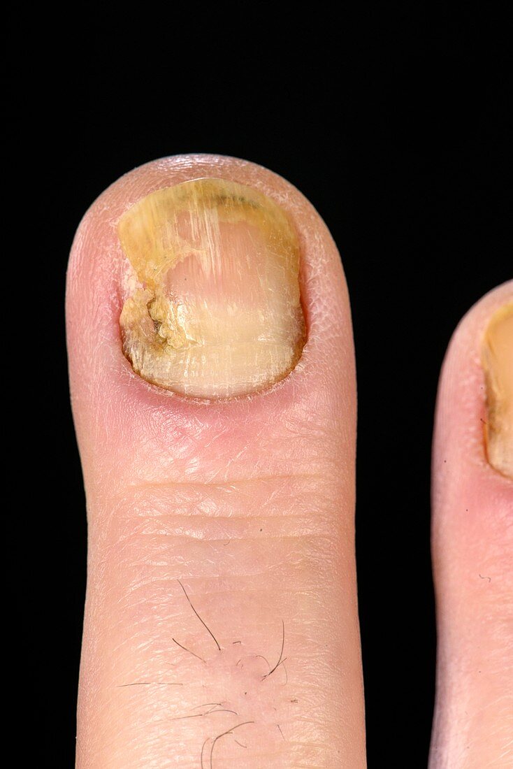 Dystrophic finger nail