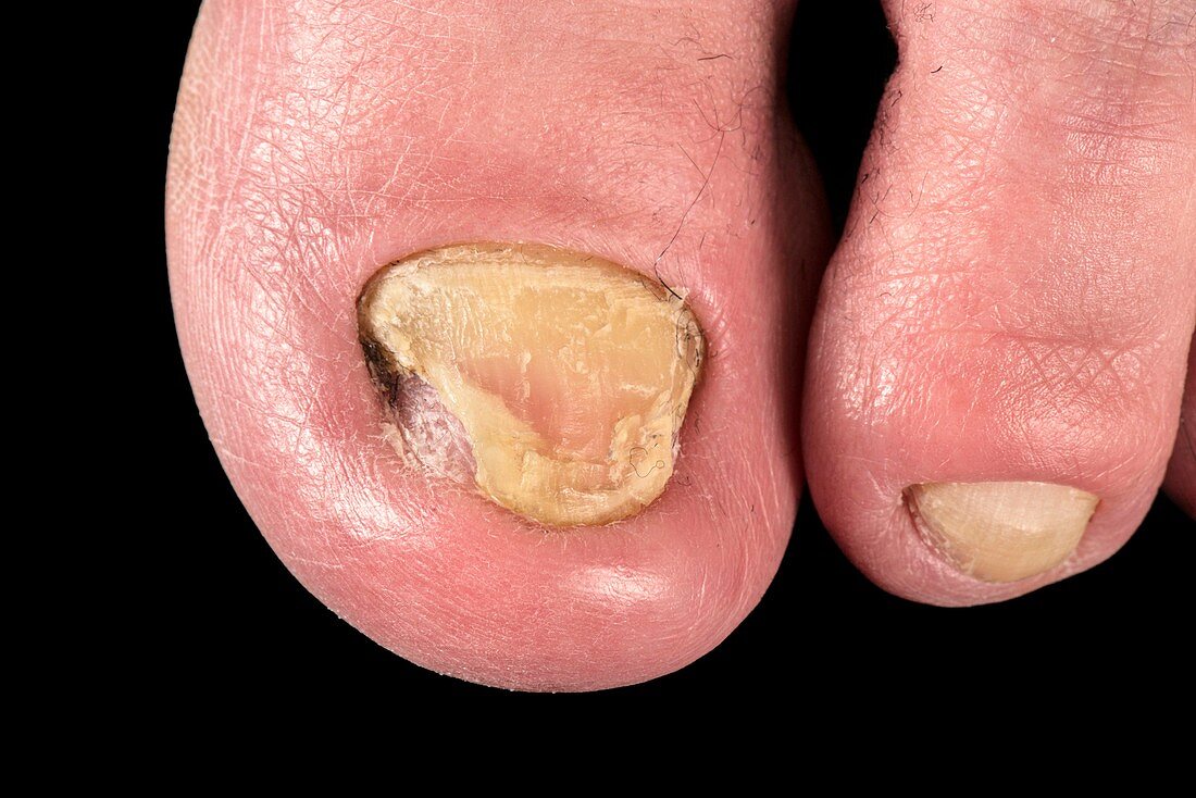Dystrophic toe nails