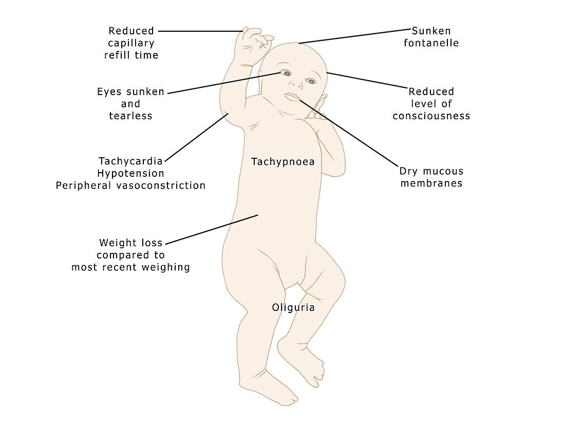 Symptoms of dehydration in babies, illustration