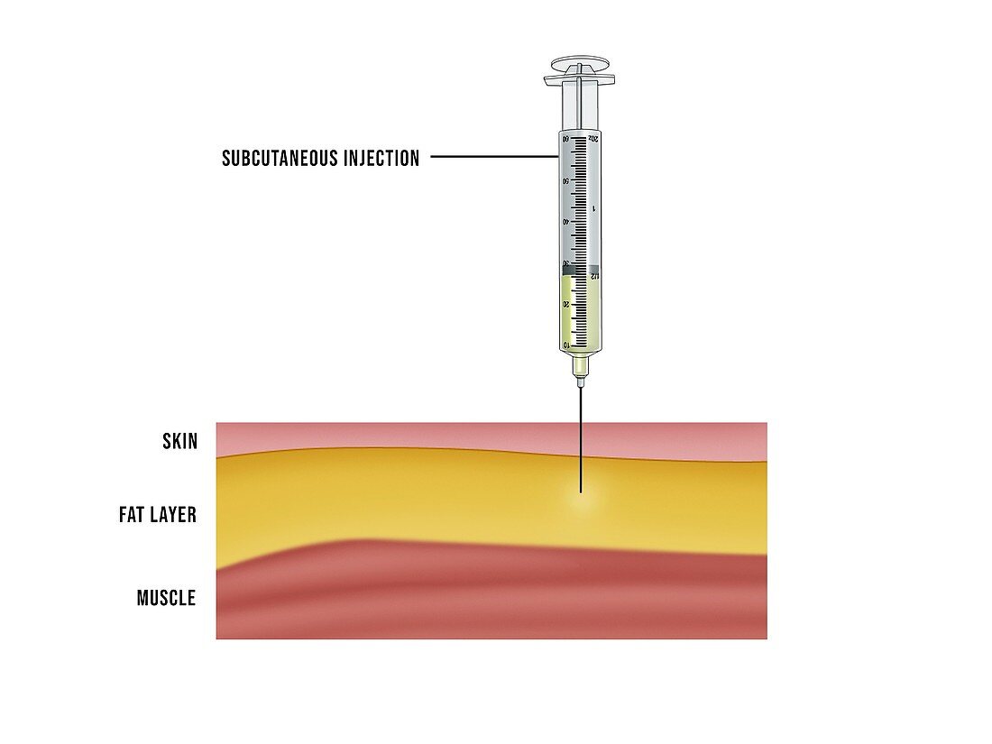 Subcutaneous injection, illustration