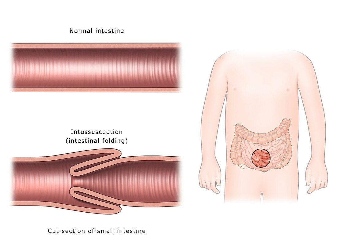Intussusception of the intestines, illustration