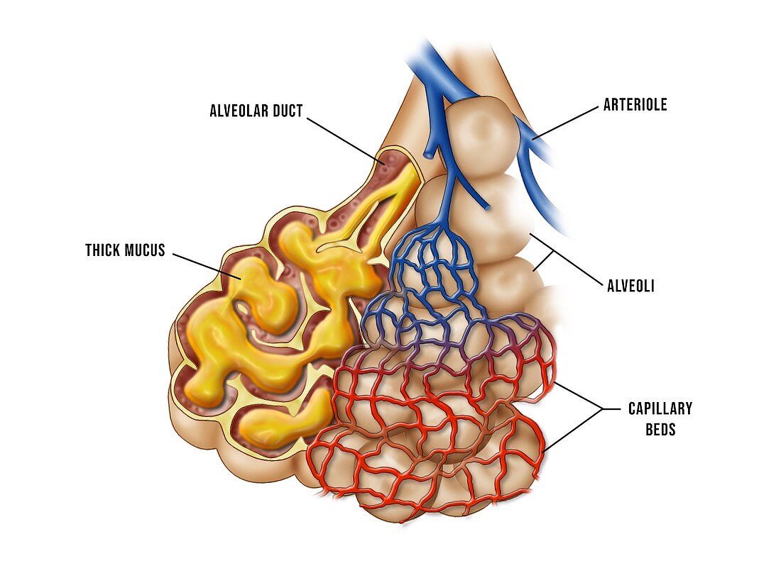 Lung alveoli in pneumonia, illustration