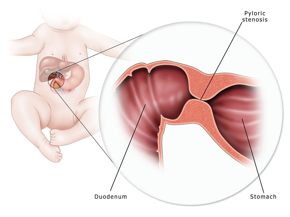 Pyloric stenosis in the stomach, illustration