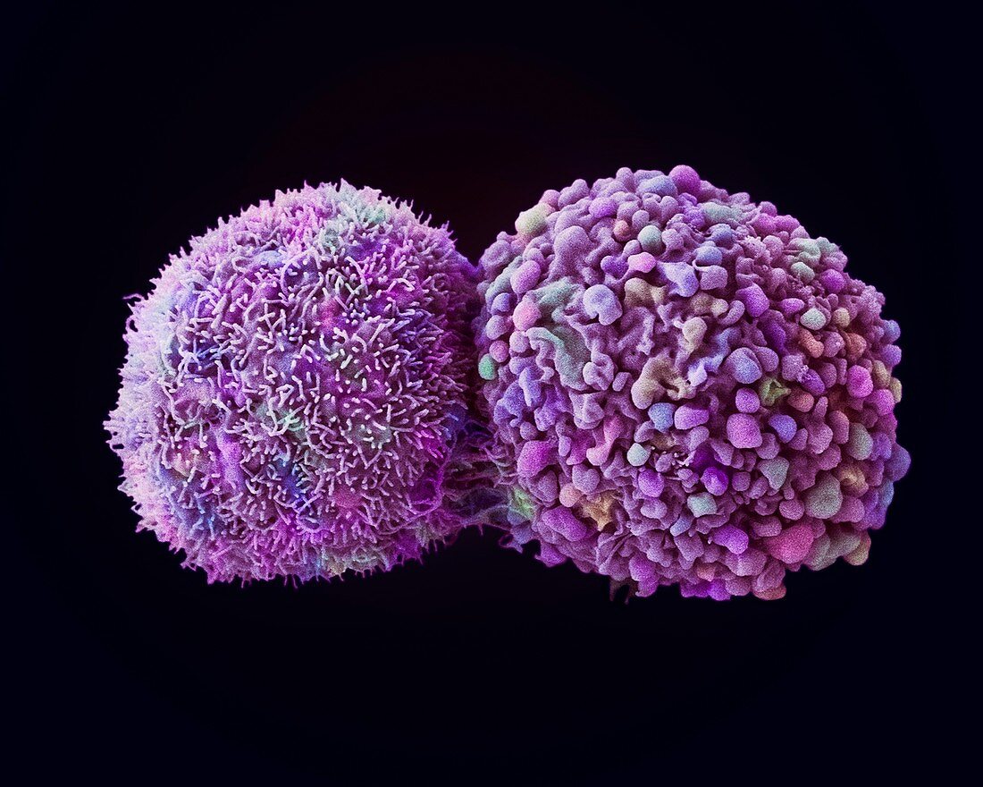 Lung cancer cells dividing, SEM