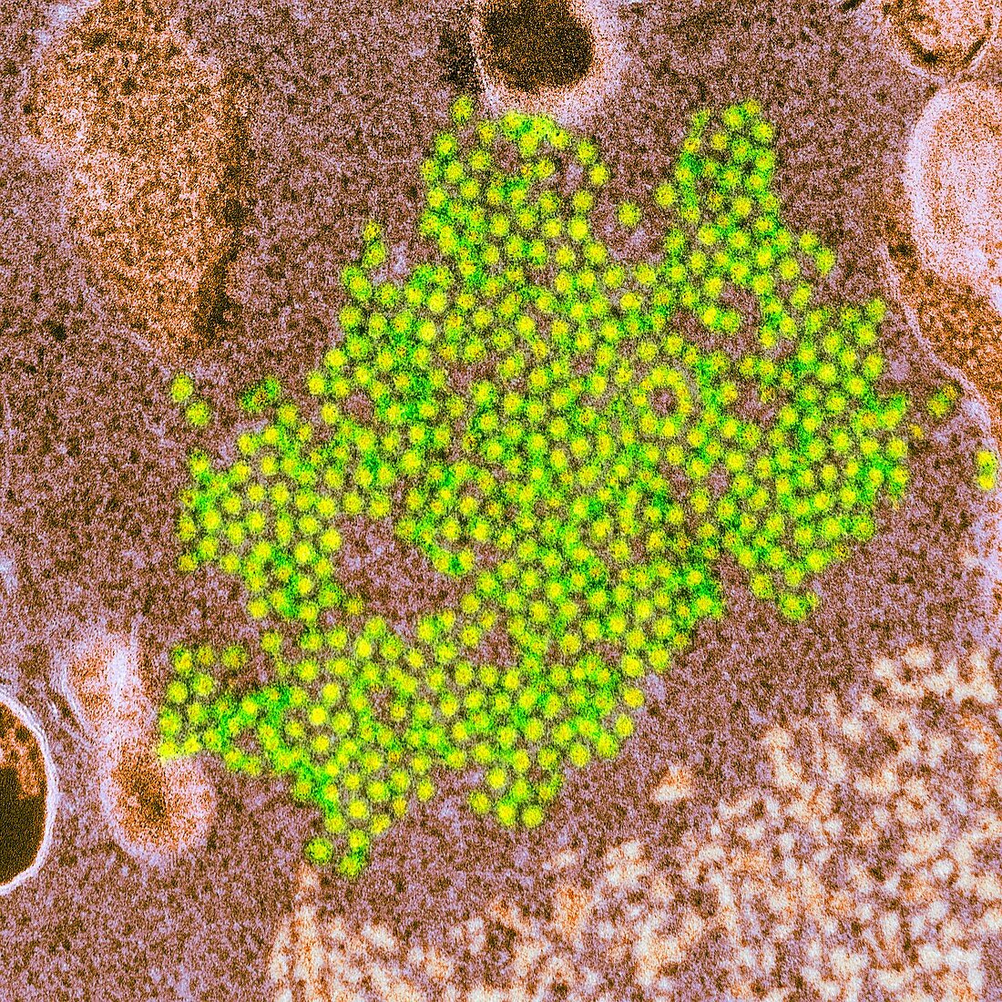 Enterovirus 68 virions, TEM