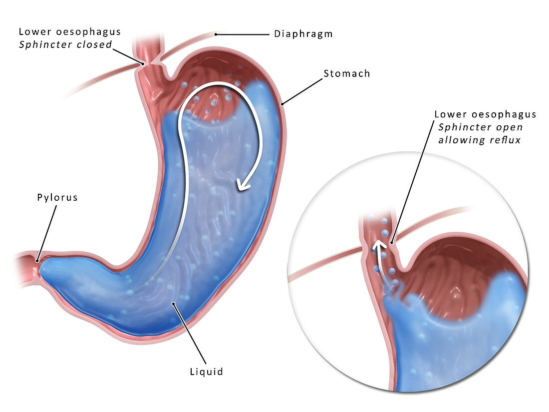 Gastric reflux disorders, illustration