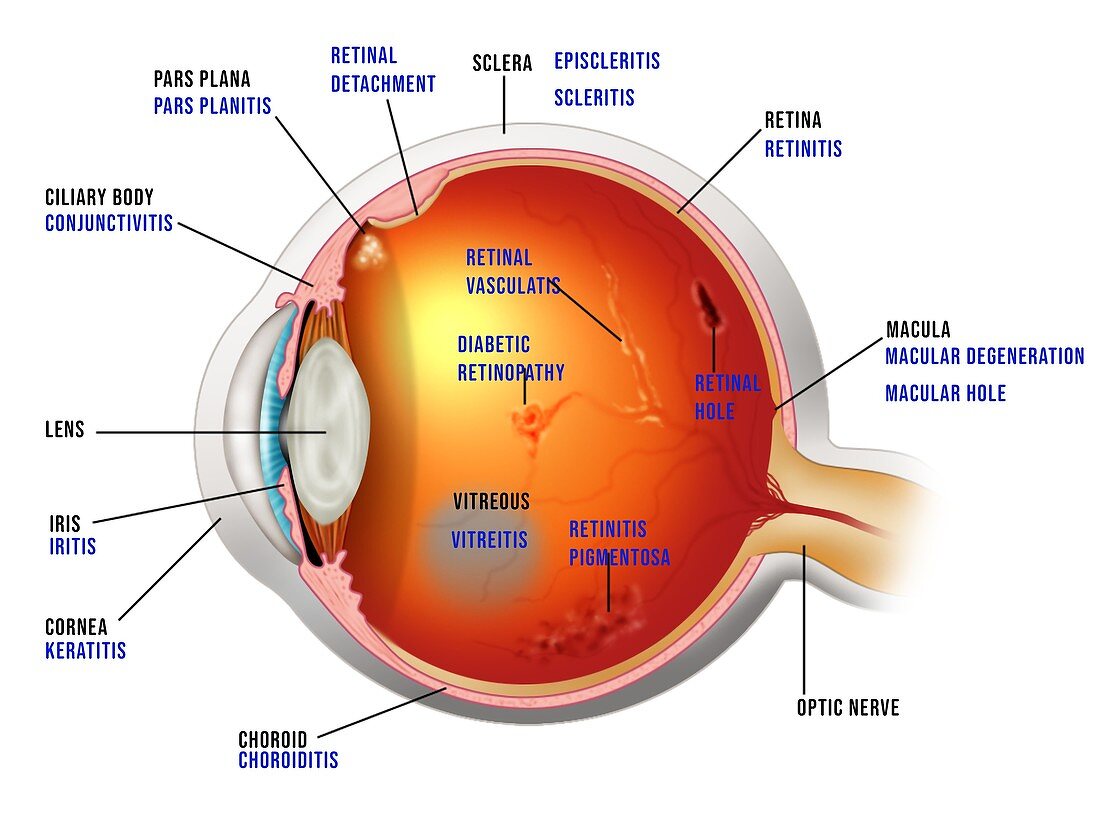 Eye diseases in slit lamp examination, illustration