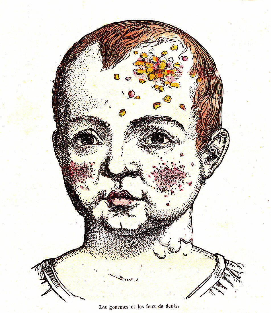 Childhood impetigo and toothache, 19th century