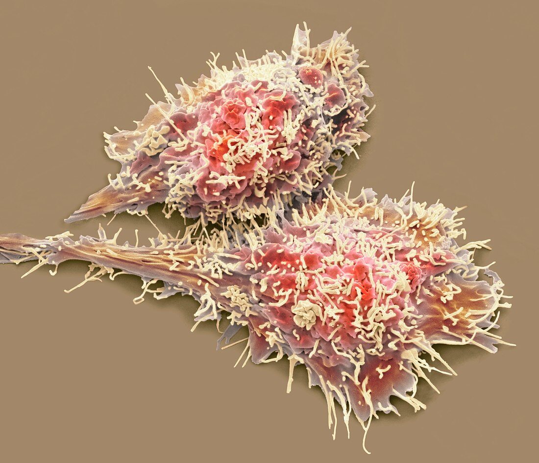 Liver cancer cells, SEM