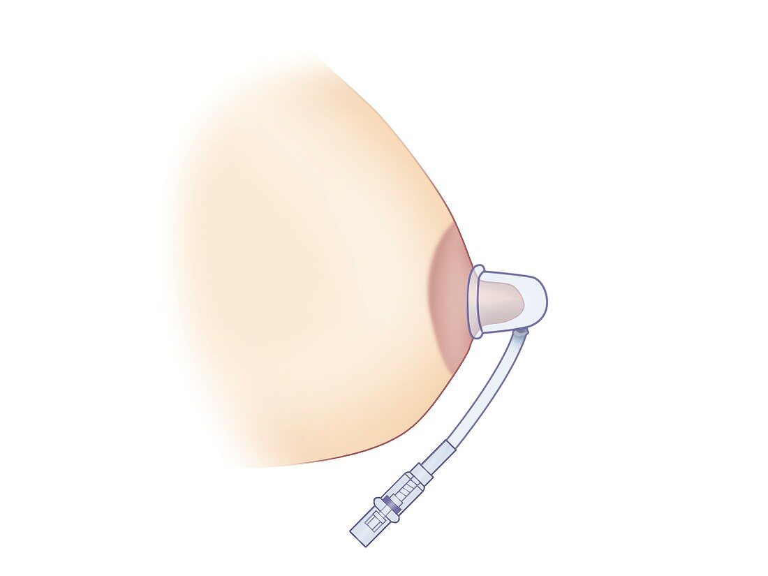 Breast pump use, illustration